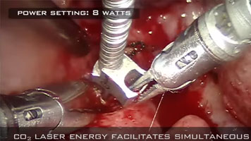 CO2 Laser: Robot Assisted Transoral Resection of Localized Cancer of the Throat