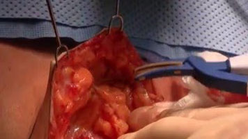 FMwand and FMsealer: Sarcoma Resection