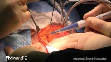 FMwand: Melanoma Excision