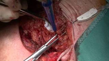 FMwand: Parotidectomy