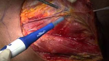 FMwand: Supracricoid Partial Laryngectomy