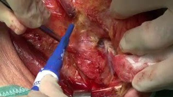 FMwand: Supraglottic Laryngectomy