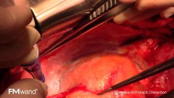 FMwand: Redo Cardiothoracic Dissection