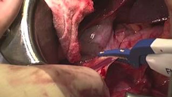 FMwand and FMsealer: Transhiatal Esophagogastrectomy