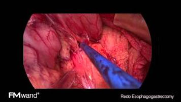 FMwand: Redo Esophagogastrectomy