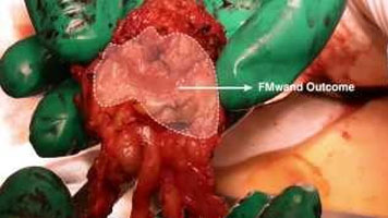 FMwand: Radical Prostatectomy