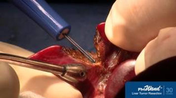 FMwand: Liver Tumor Resection