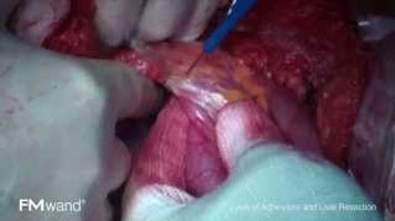 FMwand: Lysis of Adhesions and Liver Resection
