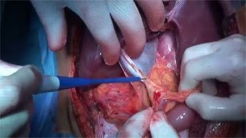 FMwand: Retroperitoneal Sarcoma Resection