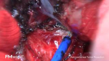 FMwand: Retroperitoneal Tumor Resection