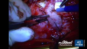 FMwand: Pericardiectomy Procedure