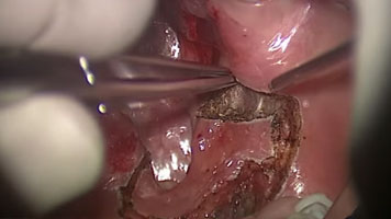 ELEVATE ENT CO2 Laser: Tonsil Cancer Resection