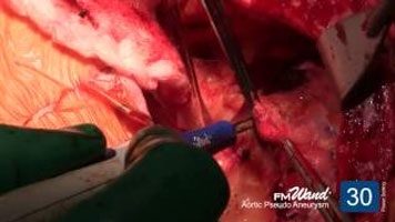 FMwand: Aortic Pseudo Aneurysm Procedure