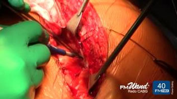 FMwand: Redo Coronary Artery Bypass Graft Procedure