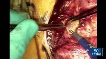 FMwand: Redo Coronary Artery Bypass Graft Procedure with Internal Mammary Artery Harvest