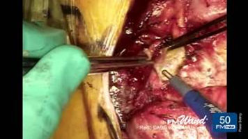 FMwand: Redo Coronary Artery Bypass Graft Procedure with Internal Mammary Artery Harvest