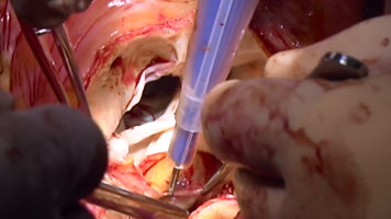 FMwand: Valve Sparing Aortic Root Replacement (David Procedure)