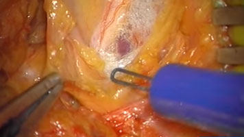 FMwand: Brachial Plexus Tumor Resection