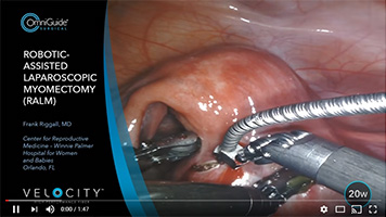 VELOCITY CO2 Laser: High Performance Fiber for Robotic Myomectomy (RALM)