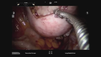 CO2 Laser: Three Port Robot Assisted Myomectomy