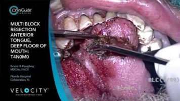 VELOCITY CO2 Laser: Deep Floor of Mouth and Anterior Glossectomy