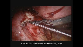 CO2 Laser: Lysis of Ovarian Adhesion