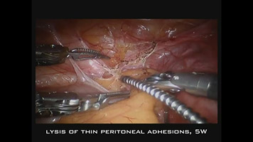 CO2 Laser: Lysis of Thin Peritoneal Adhesions