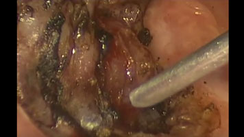 CO2 Laser: Tonsil Cancer Resection