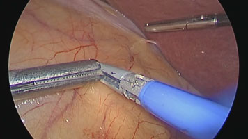 FMsealer Laparoscopic Shears: Adrenalectomy