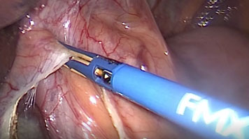 FMsealer Laparoscopic Shears: Heller Myotomy