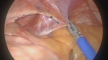 FMsealer Laparoscopic Shears: Redo Nissen Fundoplication
