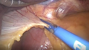 FMsealer Laparoscopic Shears: Toupet Fundoplication