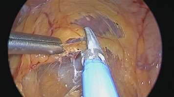 FMsealer Laparoscopic Shears: Toupet Fundoplication