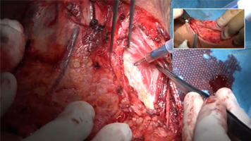 FMwand: Anterior Oral Pelvectomy