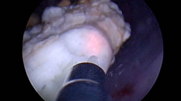 Fragmentation of Bladder Stone on Encrusted Catheter