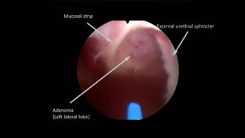 Holmium Laser Enucleation (HoLEP) of the Prostate