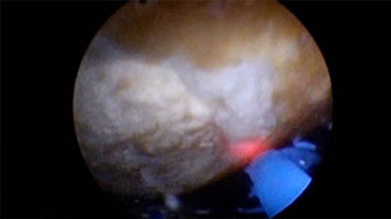 Renal Pelvis Calculus