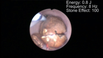 Ureter Stone Lithotripsy