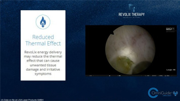 Revolix HTL BPH Enucleation